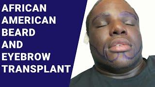 African-American Beard & Eyebrow Transplants