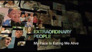 My Face Is Eating Me Alive - Extraordinary People - CHANNEL 5