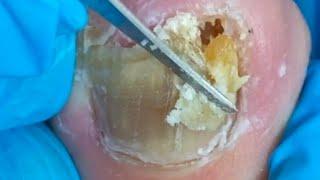 Wow, Huge Ingrown Toenail, Trim It Carefully【Crazy pedicure room】