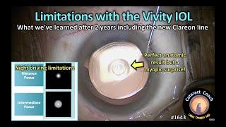 CataractCoach 1643: limitations with the Vivity IOL (extended depth of focus)