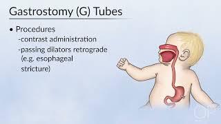 Indications for Gastrostomy Tube Placement by L. Armstrong, K. Schlosser | OPENPediatrics