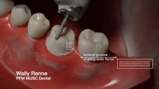 PFM Crown  Prep and animation for Dental Students