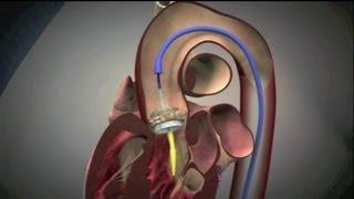 Transcatheter Aortic Valve Implantation (TAVI)