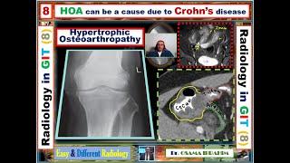 Hypertrophic OsteoArthropathy and Crohn's disease