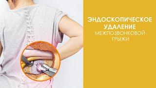 Эндоскопическое удаление межпозвонковой грыжи