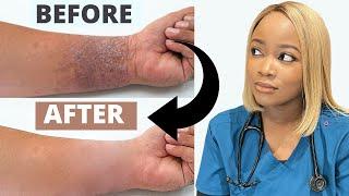 How to Treat ECZEMA | Black Brown skin | Dry Skincare Routine| The #1 Best Remedy for Eczema