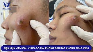 ĐIỀU TRỊ MỤN VIÊM TỤ CẦU HIỆU QUẢ, CAM KẾT -  KHÔNG SƯNG VIÊM, KHÔNG TÁI LẠI, KHÔNG ĐỂ LẠI SẸO.