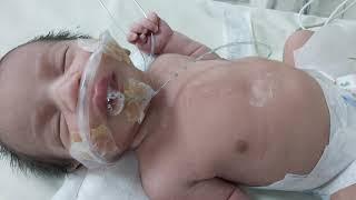 case 447 DD respiratory distress in newborn, TTN ,delayed transition, MAS, PPPN, pneumonia, sepsis