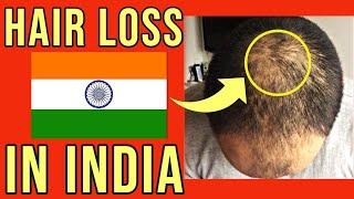 BEING BALD AND INDIAN | Why Is HAIR LOSS Such A Big Deal In The Asian Community? | Balding Advice