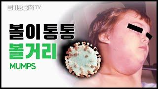 볼거리(유행성이하선염)에 걸리면 귀가 멀 수도 있습니다. Mumps [feat. 닥터X]