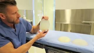 Buttock implants, Stanton Anatomic Implants projection vs Round implants| call Dr Stanton (310)486-