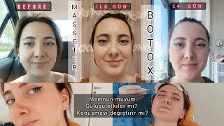 MASSETER BOTOX YAPTIRDIM! | ETKİLERİ NELER ? , 1 AYLIK SÜREÇ