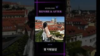 팔 지방흡입 #팔지방흡입