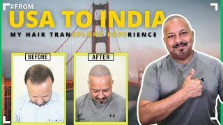 I Had the BEST Hair Transplant Experience in INDIA | Hair Transplant Clinic In Bhubaneswar