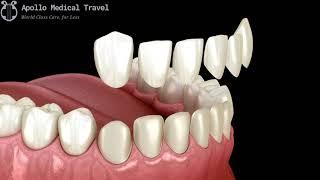 Animated Veneers Procedure | Apollo Medical Travel