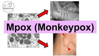 Mpox (Monkeypox) | Transmission, Pathophysiology, Signs & Symptoms, Diagnosis, Treatment