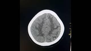 Follow up  scan of Radiation induced leukoencephalopathy, progression of obstructive hydrocephalus.