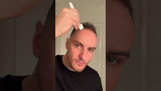 Derma stamp tutorial #hair #hairgrowth #hairtransformation #dermastamp #microneedling #dermaroller