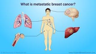 Understanding metastatic breast cancer