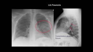 Chest X-ray: Cases 1