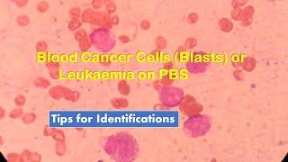 Blood Cancer Cells ( Blasts) or Leukemia on Peripheral Blood Smear Observation and Identifications