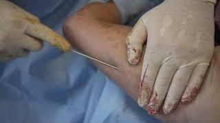 Smart Lipo at Carolina Age Management Institute - A short introduction to how we do it