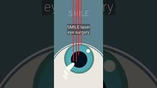 How Laser Eye Surgery Works! #shorts