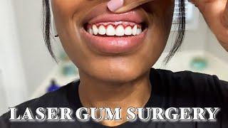 LASER GUM SURGERY | TEETH JOURNEY: Gum Contouring, Gummy Smile, Crown Lengthening, Smile Direct Club