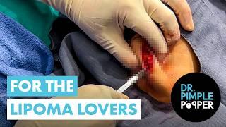 For the Lipoma Lovers