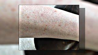 Seborrheic Keratosis: What Is It & How to Treat It