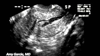 Evaluation of the endometrial cavity using sonohysterography