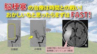 脳梗塞の治療は時間との戦い！おかしいなと思ったらまずはFAST!!
