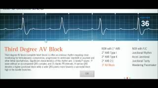 Easy EKG: Interpreting Rhythms