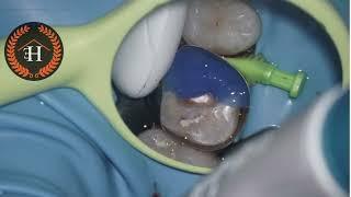 Pre-endodontic build-up