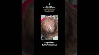 ALOPECIA FEMENINA O CALVICIE FEMENINA - Dr. Alejandro de Aguinaga Inurriaga - Dermatólogo