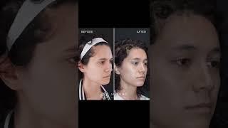 Facial Feminization Surgery (FFS) Before and After, Dr. Sarah Saxon