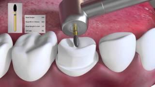 Crown preparation tutorial by Prof. Brian Millar