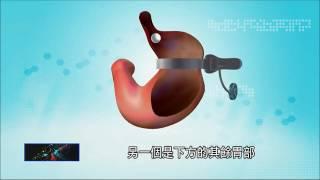 【TVBS科學不一樣】減重手術體重管理中心 王偉主任