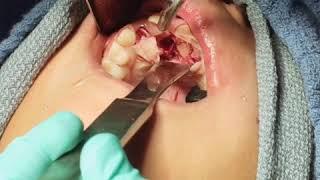 Supernumerary Teeth & Mesiodens - Extraction