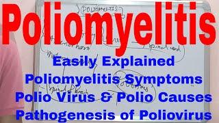 Poliomyelitis|What is Poliomyelitis|Poliomyelitis Symptoms|Polio Causes|Pathogenesis of Poliovirus