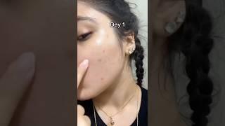 Clear Dark Spots Naturally – Try This Now!  #skincare #brightskin #glowup2025