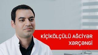 Kiçikölçülü ağciyər xərçəngi  - Torakal cərrah Uzm.Dr. Nurlan Əlizadə