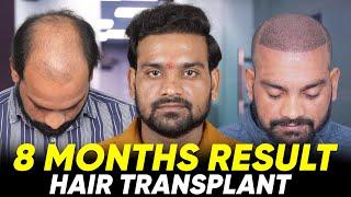 Hair Transplant in Chennai | Best Results & Cost of Hair Transplant in Chennai