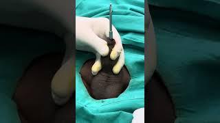 ZSR circumcision -painless and bloodless procedure