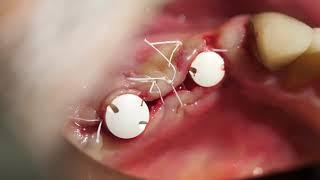 Surgical Placement of 3 Z-systems Ceramic Implants