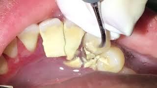 Houston Cosmetic Dentist....Tartar! Tartar! Tartar!  How we remove it...