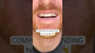 Watch Dr. Kunal create a natural, proportionate smile using #compositebonding.  #ruhdental