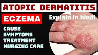 eczema | atopic dermatitis | in hindi | cause, symptoms, treatment, nursing management |skin disease