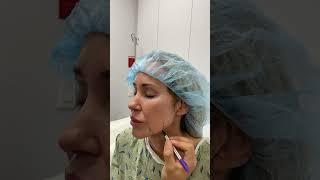 Facelift Surgery: An Inside Look At Plastic Surgeon's Marking Process