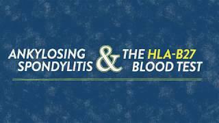 HLA-B27: An Important Genetic Marker for Ankylosing Spondylitis